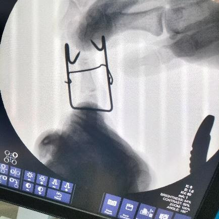 Dynamic external fixator for phalanx fracture3